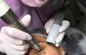 Фракционное омоложение лица: особенности методики