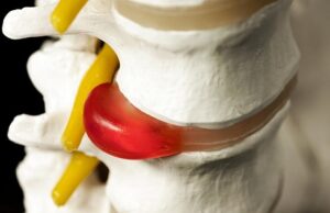 Грыжа позвоночника: причины ее возникновения